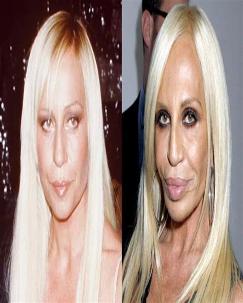 failed plastic surgeries|worst before and after pictures.